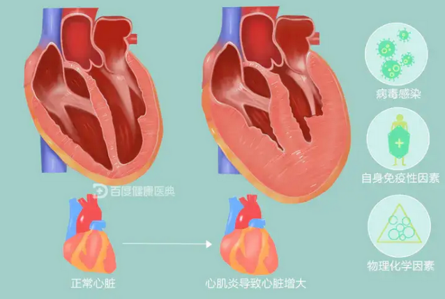 心肌炎